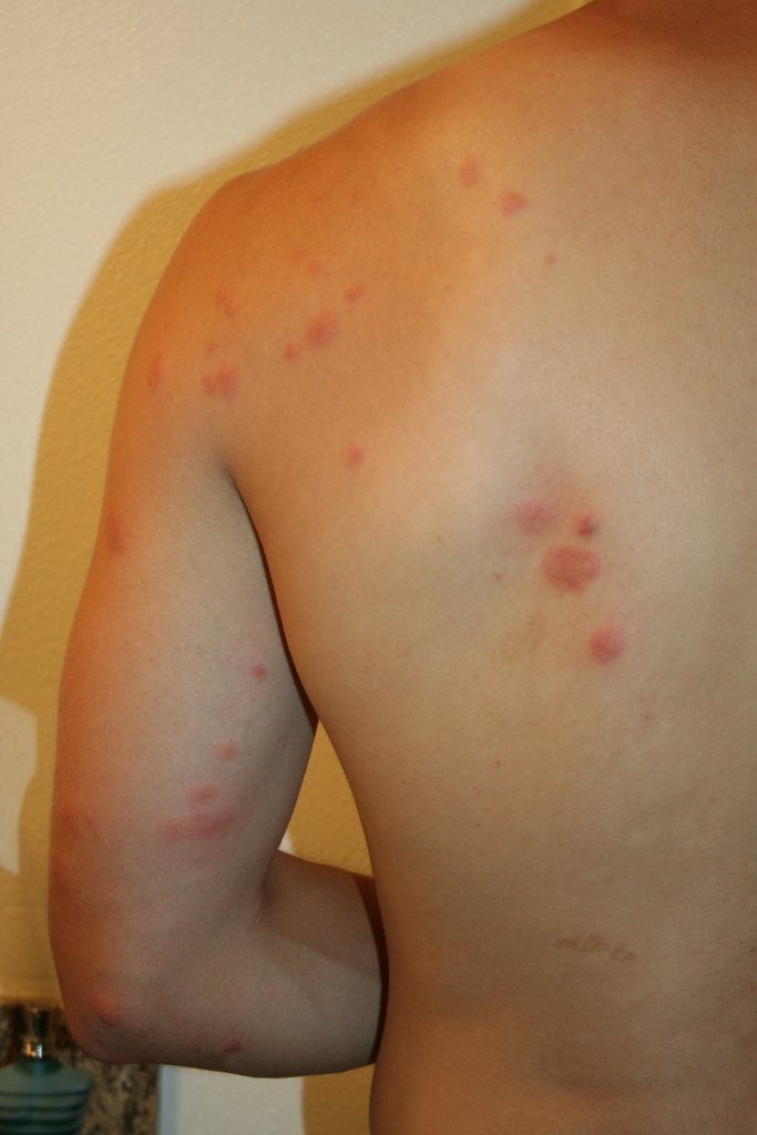 I got flea bites on my back everywhere when i went to ...