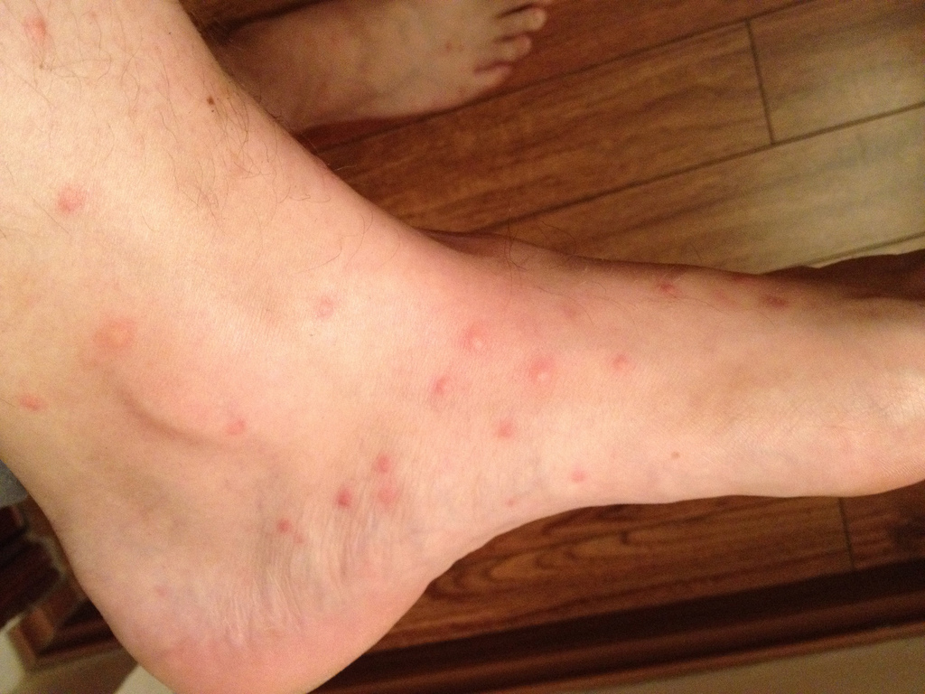 Picture of Flea Bites - WebMD