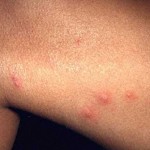 Flea bites on Humans