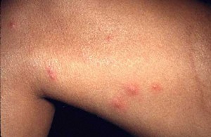 Flea bites on Humans