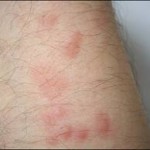 Flea bites on Humans