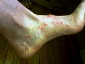 sand flea bites