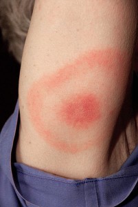 Erythema on the lower back.